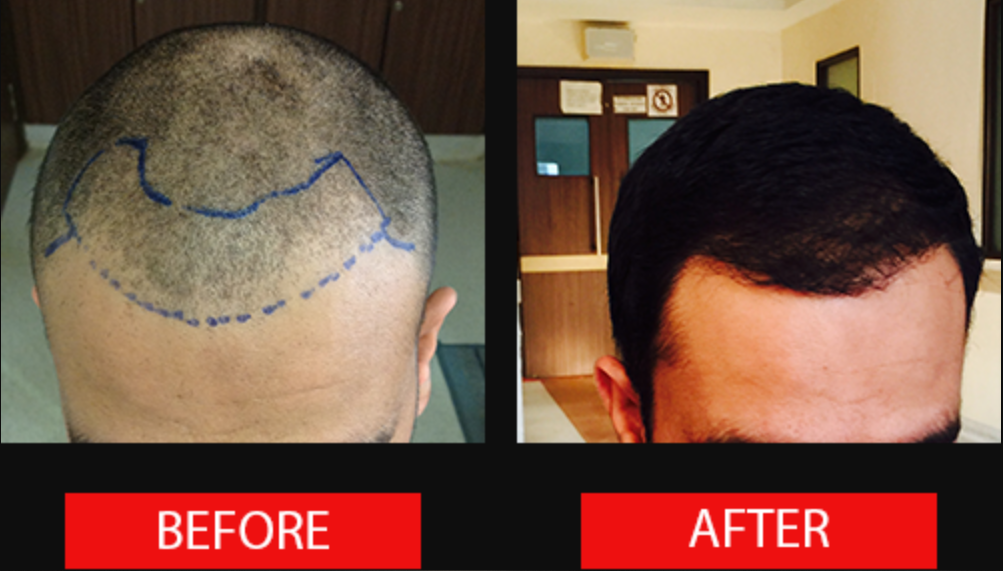 successful hair transplant